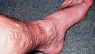 Αιτίες των κιρσών στα πόδια στους άνδρες