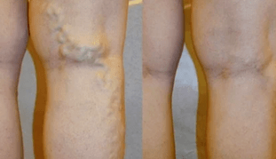 Σημάδια και συμπτώματα των κιρσών στα πόδια στους άνδρες