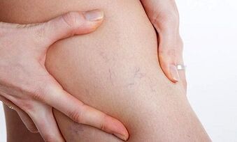 Λόγοι για την ανάπτυξη κιρσών στα πόδια