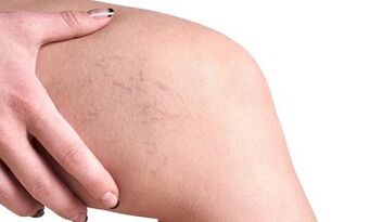 Στάδια ανάπτυξης κιρσών