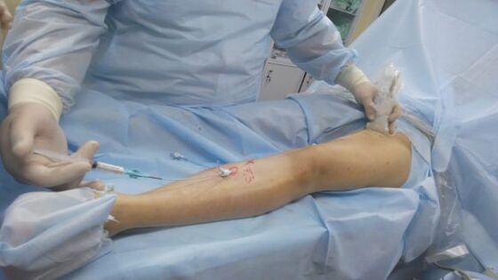 Χειρουργική επέμβαση για κιρσούς στα πόδια