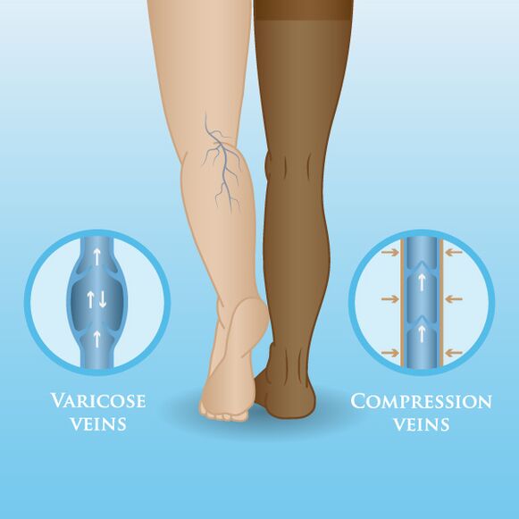 Επιδράσεις των ενδυμάτων συμπίεσης στις κιρσούς στα πόδια