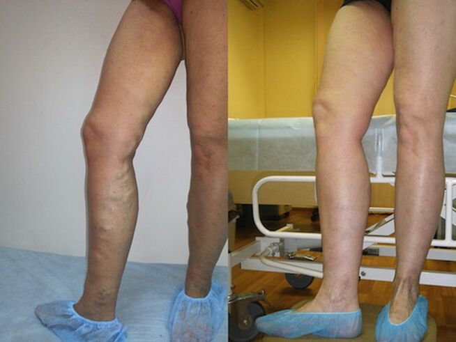 Πόδια πριν και μετά από θεραπεία με κιρσούς με λέιζερ