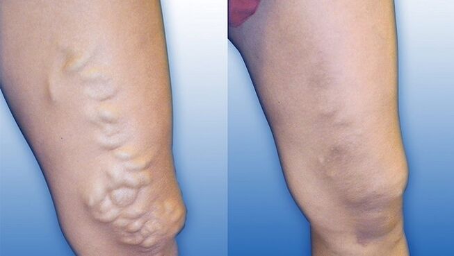 Πόδια πριν και μετά από σοβαρή θεραπεία για κιρσούς